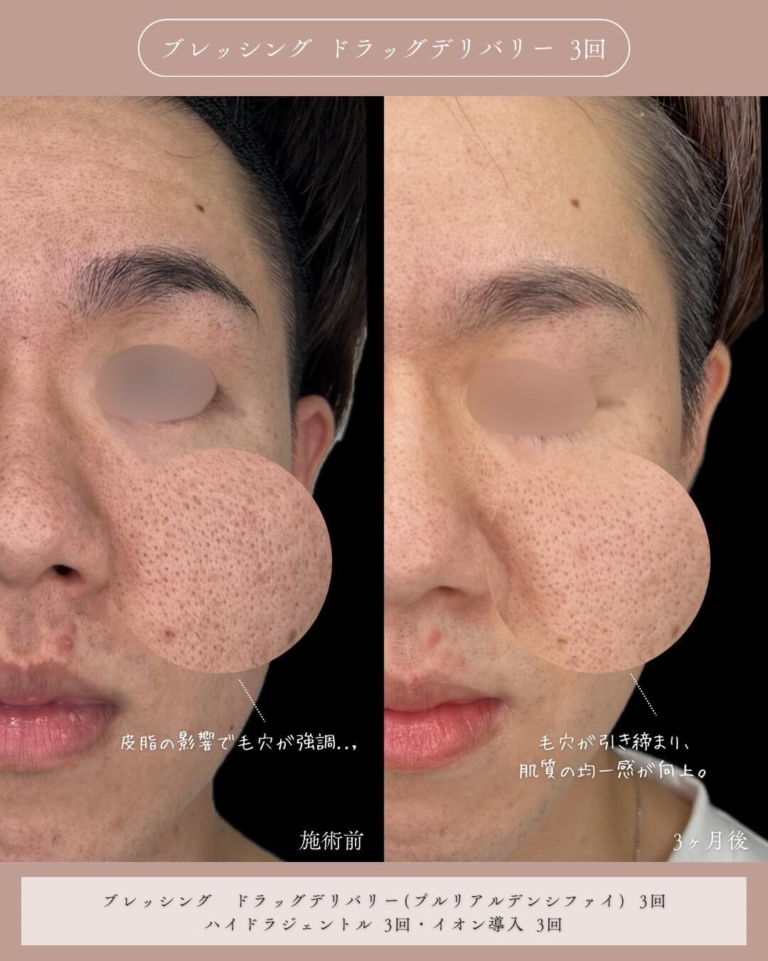 ブレッシング ドラッグデリバリー 3回 施術前 皮脂の影響で毛穴が強調 3ヶ月後 毛穴が引き締まり、肌質の均一感が向上。 ブレッシング ドラッグデリバリー(プルリアルデンシファイ) 3回 ハイドラジェントル 3回・イオン導入3回