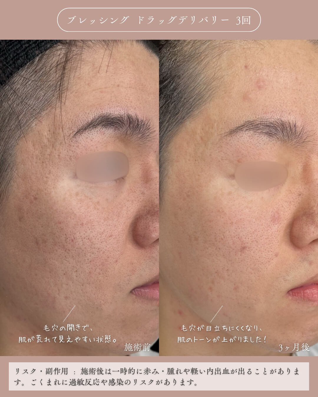 ブレッシング ドラッグデリバリー 3回 施術前 毛穴の開きで肌が荒れて見えやすい状態。 3ヶ月後 毛穴が目立ちにくくなり、肌のトーンが上がりました！ リスク・副作用：施術後は一時的に赤み・腫れや軽い内出血が出ることがあります。ごくまれに過敏反応や感染のリスクがあります。