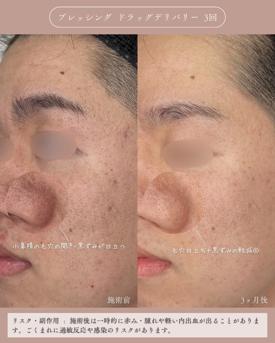 ブレッシング ドラッグデリバリー 3回 施術前 小鼻横の毛穴の開き・黒ずみが目立つ 3ヶ月後 毛穴目立ち＋黒ずみの軽減 リスク・副作用：施術後は一時的に赤み・腫れや軽い内出血が出ることがあります。ごくまれに過敏反応や感染のリスクがあります。