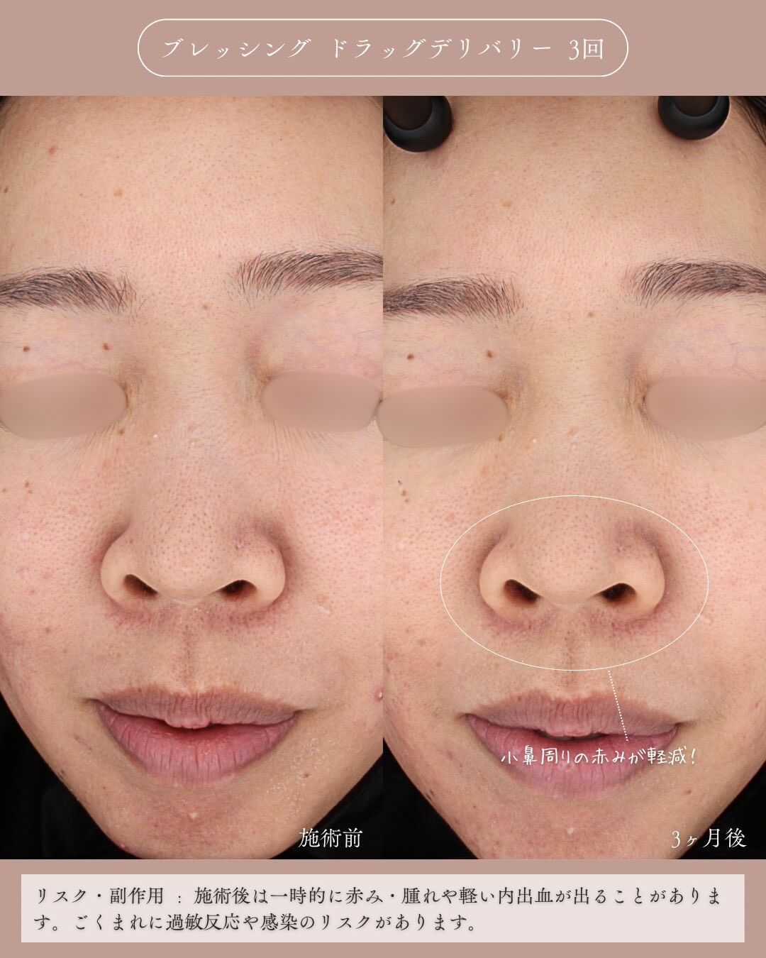 ブレッシング ドラッグデリバリー 3回 施術前 3ヶ月後 小鼻周りの赤みが軽減 リスク・副作用：施術後は一時的に赤み・腫れや軽い内出血が出ることがあります。ごくまれに過敏反応や感染のリスクがあります。