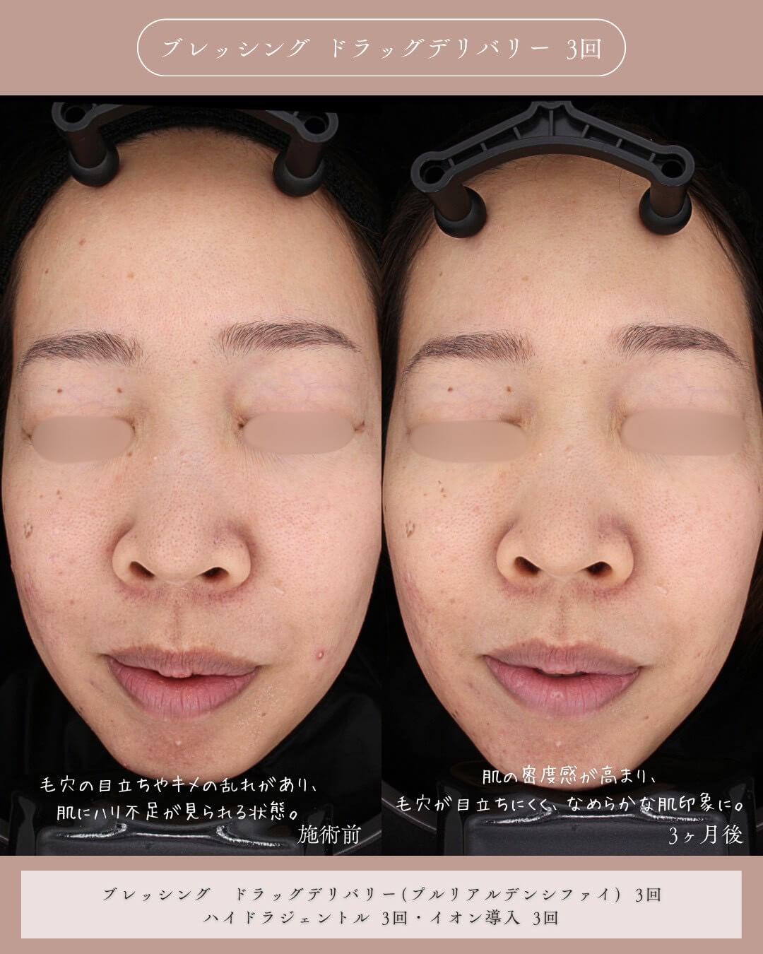 ブレッシング ドラッグデリバリー 3回 施術前 毛穴の目立ちやキメの乱れがあり、肌にハリ不足が見られる状態。 3ヶ月後 肌の密度感が高まり、毛穴が目立ちにくく、なめらかな肌印象に。 ブレッシング ドラッグデリバリー(プルリアルデンシファイ) 3回 ハイドラジェントル 3回・イオン導入 3回