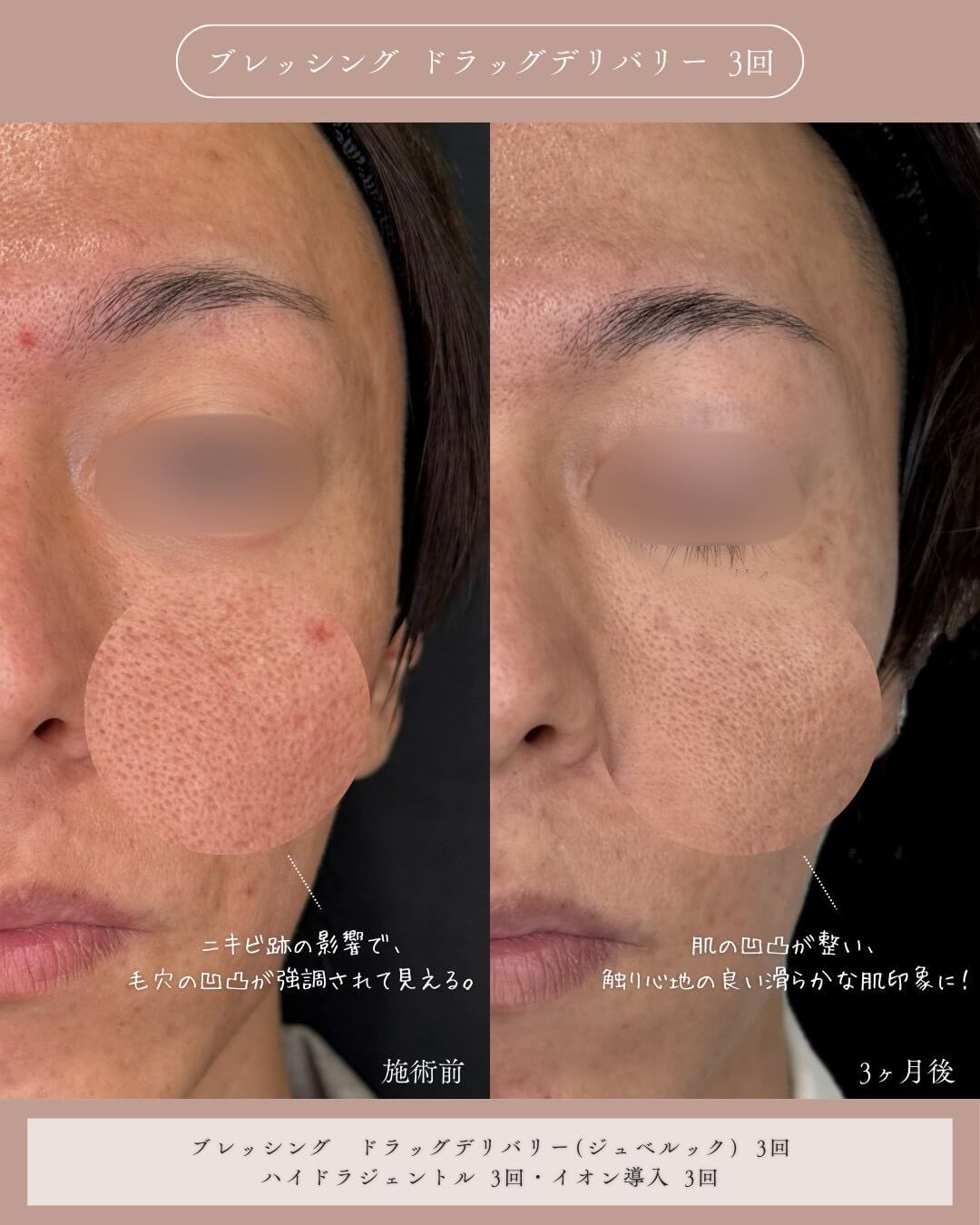 ブレッシング ドラッグデリバリー 3回 施術前 ニキビ跡の影響で、毛穴の凹凸が強調されて見える。 3ヶ月後 肌の凹凸が整い、触り心地の良い滑らかな肌印象に！ ブレッシング ドラッグデリバリー(ジュベルック) 3回 ハイドラジェントル 3回・イオン導入 3回