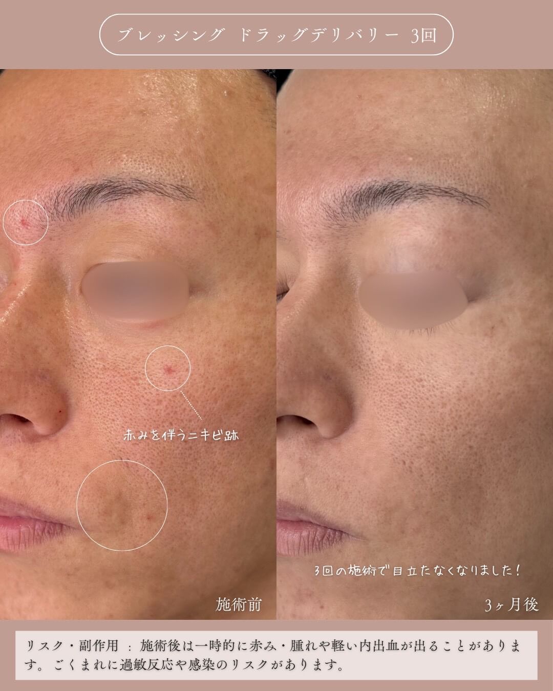 ブレッシング ドラッグデリバリー 3回 施術前 赤みを伴うニキビ後 3ヶ月後 3回の施術で目立たなくなりました！ リスク・副作用；施術後は一時的に赤み・腫れや軽い内出血が出ることがあります。ごくまれに過敏反応や感染のリスクがあります。