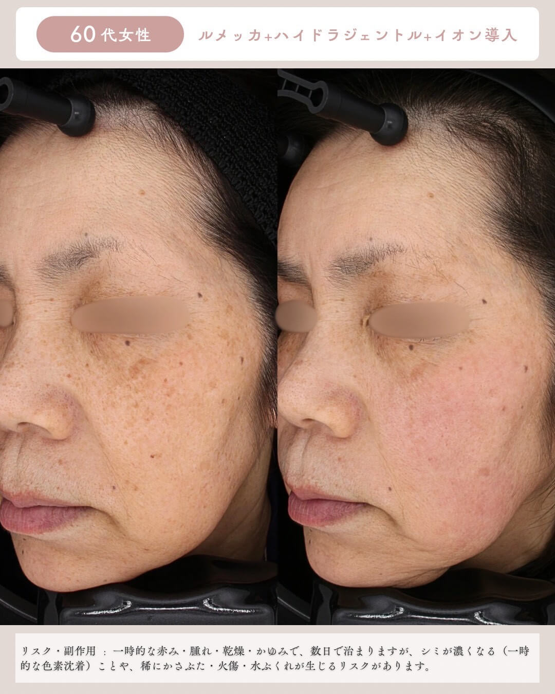60代女性 ルメッカ＋ハイドラジェントル＋イオン導入 リスク・副作用：一時的な赤み・腫れ・乾燥・かゆみで、数日で治りますが、シミが濃くなる(一時的な色素沈着)ことや、稀にかさぶた・火傷・水ぶくれが生じるリスクがあります。