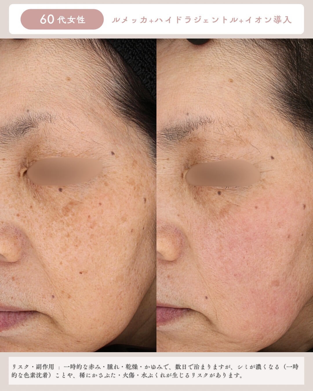 60代女性 ルメッカ＋ハイドラジェントル＋イオン導入 リスク・副作用：一時的な赤み・腫れ・乾燥・かゆみで、数日で治りますが、シミが濃くなる(一時的な色素沈着)ことや、稀にかさぶた・火傷・水ぶくれが生じるリスクがあります。