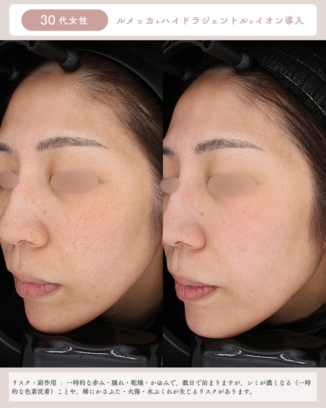 30代女性 ルメッカ＋ハイドラジェントル＋イオン導入 リスク・副作用：一時的な赤み・腫れ・乾燥・かゆみで、数日で治りますが、シミが濃くなる(一時的な色素沈着)ことや、稀にかさぶた・火傷・水ぶくれが生じるリスクがあります。