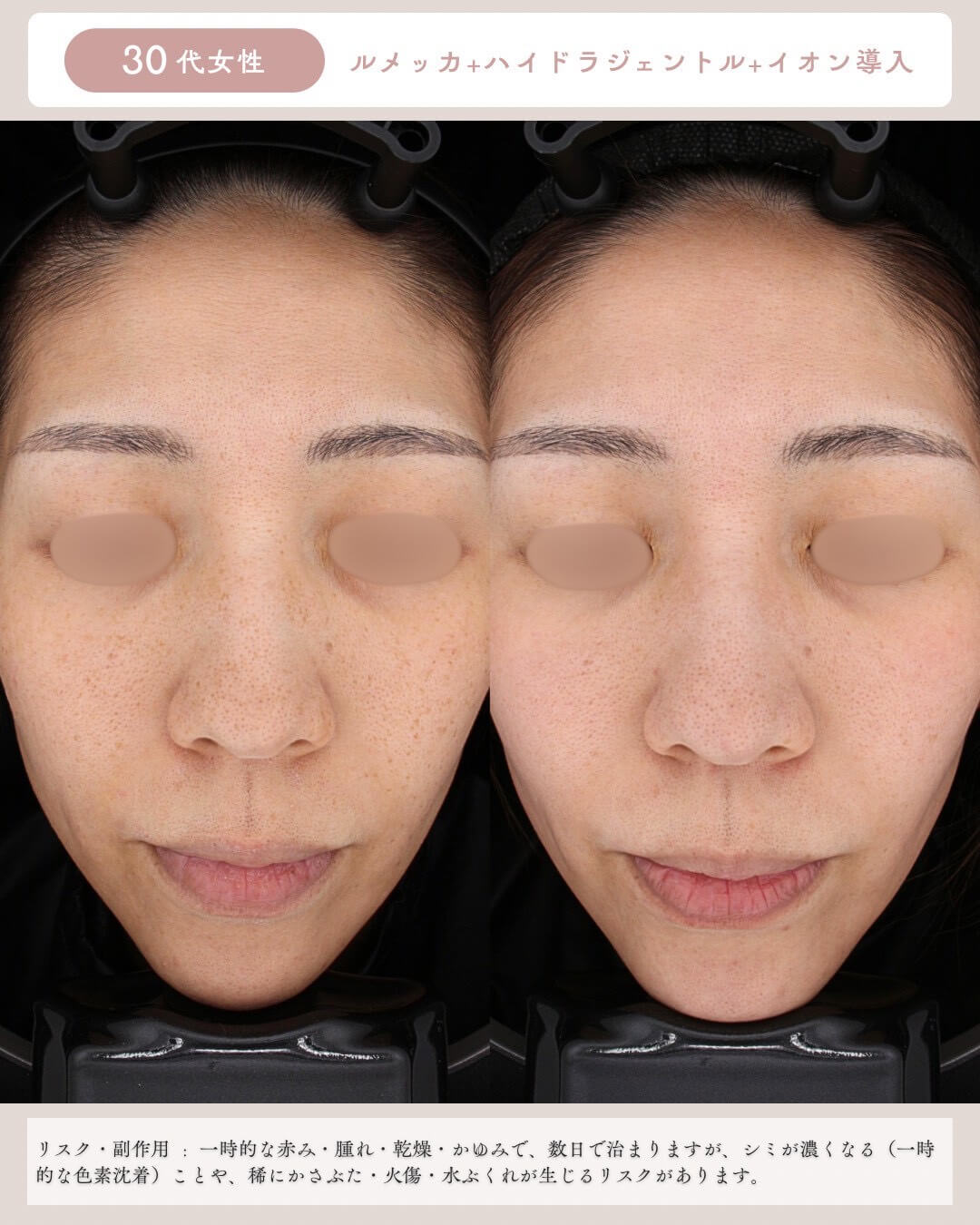 30代女性 ルメッカ＋ハイドラジェントル＋イオン導入 リスク・副作用：一時的な赤み・腫れ・乾燥・かゆみで、数日で治りますが、シミが濃くなる(一時的な色素沈着)ことや、稀にかさぶた・火傷・水ぶくれが生じるリスクがあります。
