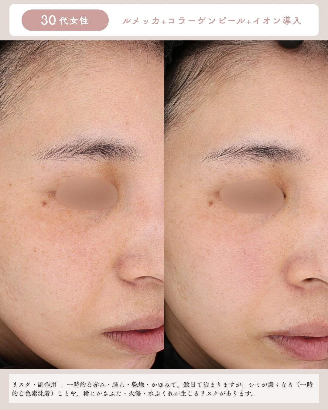 30代女性 ルメッカ＋コラーゲンビール＋イオン導入 リスク・副作用：一時的な赤み・腫れ・乾燥・かゆみで、数日で治りますが、シミが濃くなる(一時的な色素沈着)ことや、稀にかさぶた・火傷・水ぶくれが生じるリスクがあります。