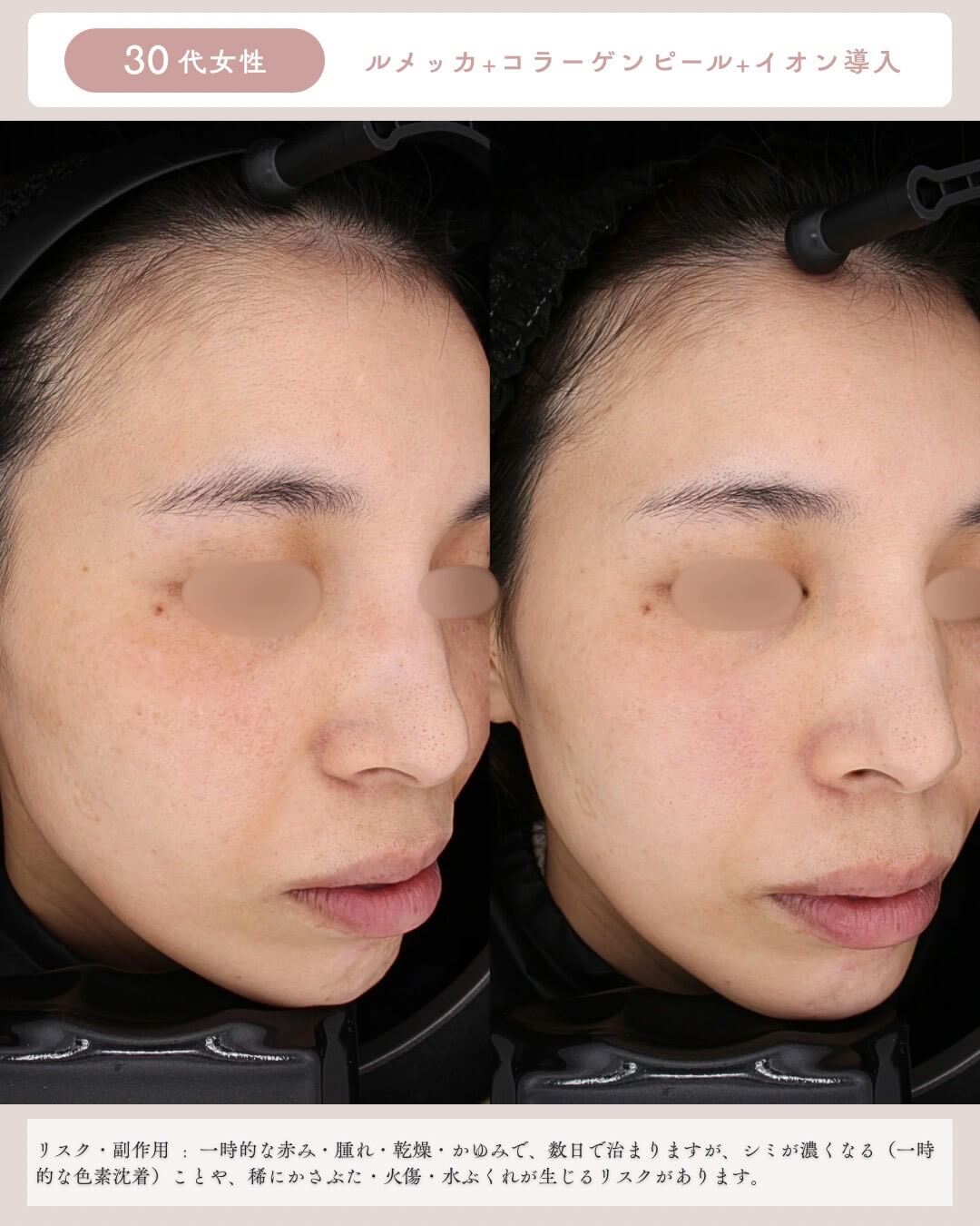 30代女性 ルメッカ＋コラーゲンビール＋イオン導入 リスク・副作用：一時的な赤み・腫れ・乾燥・かゆみで、数日で治りますが、シミが濃くなる(一時的な色素沈着)ことや、稀にかさぶた・火傷・水ぶくれが生じるリスクがあります。