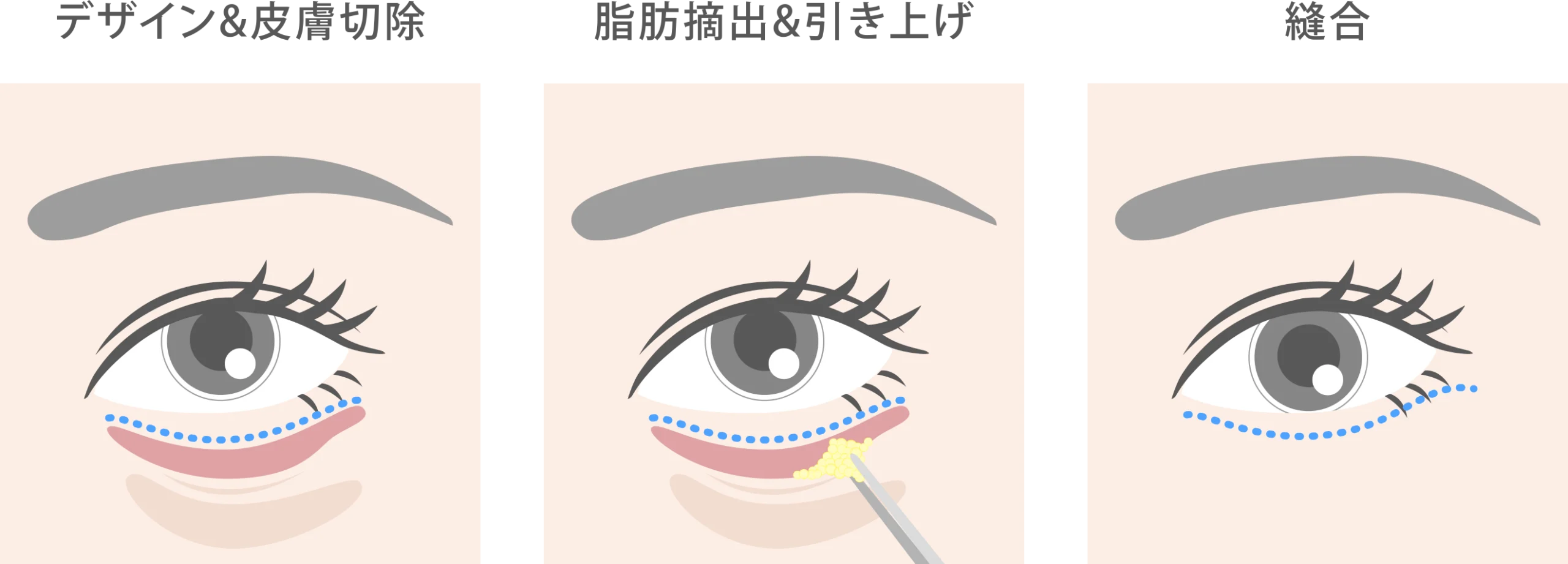 下眼瞼たるみ取り（余剰皮膚切除）