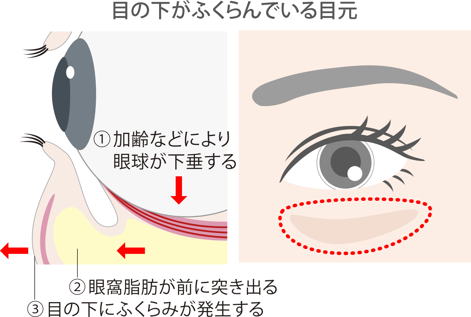 目の下がふくらんでいる目元