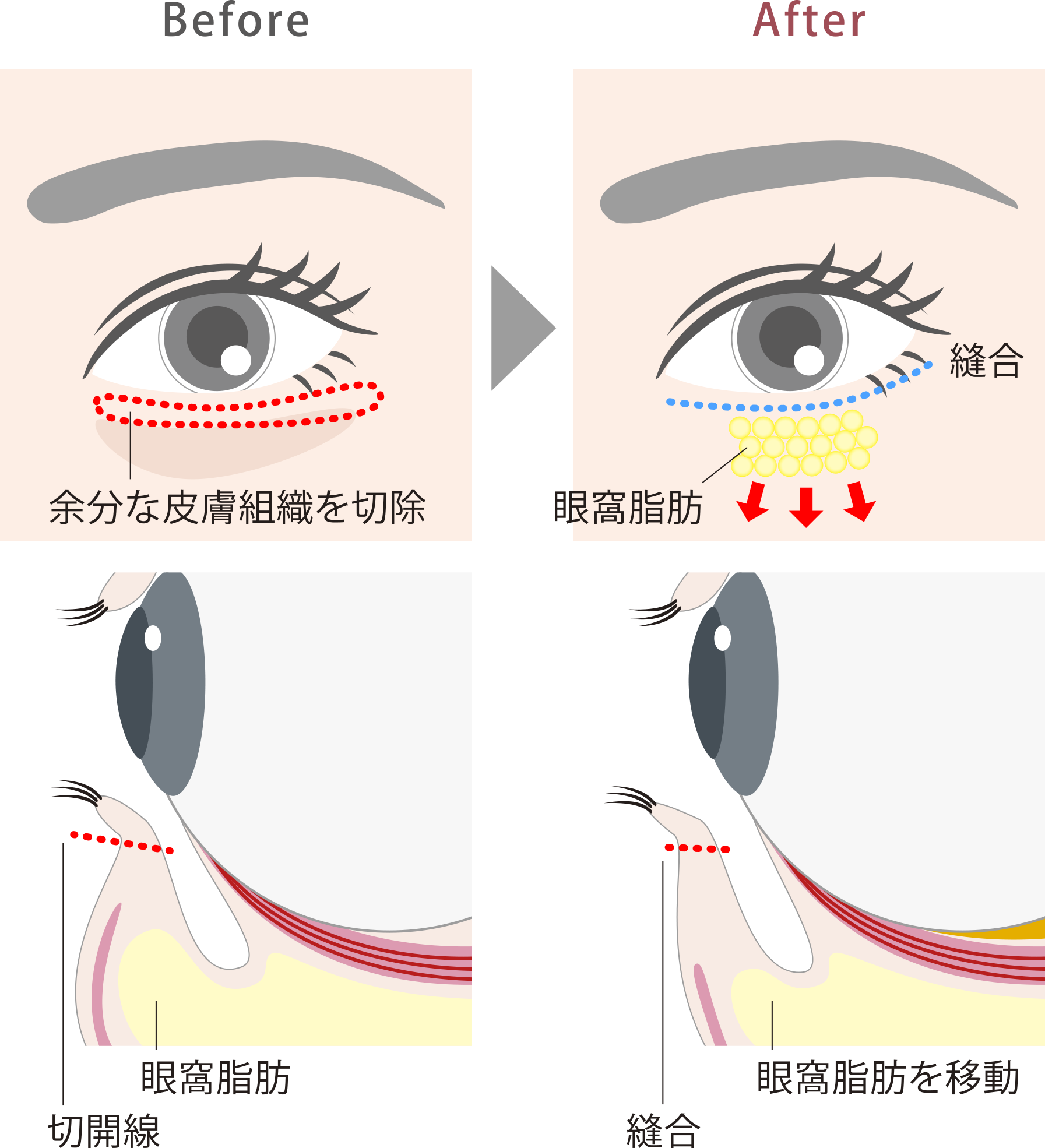 ハムラ法