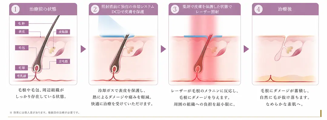 医療脱毛の流れ