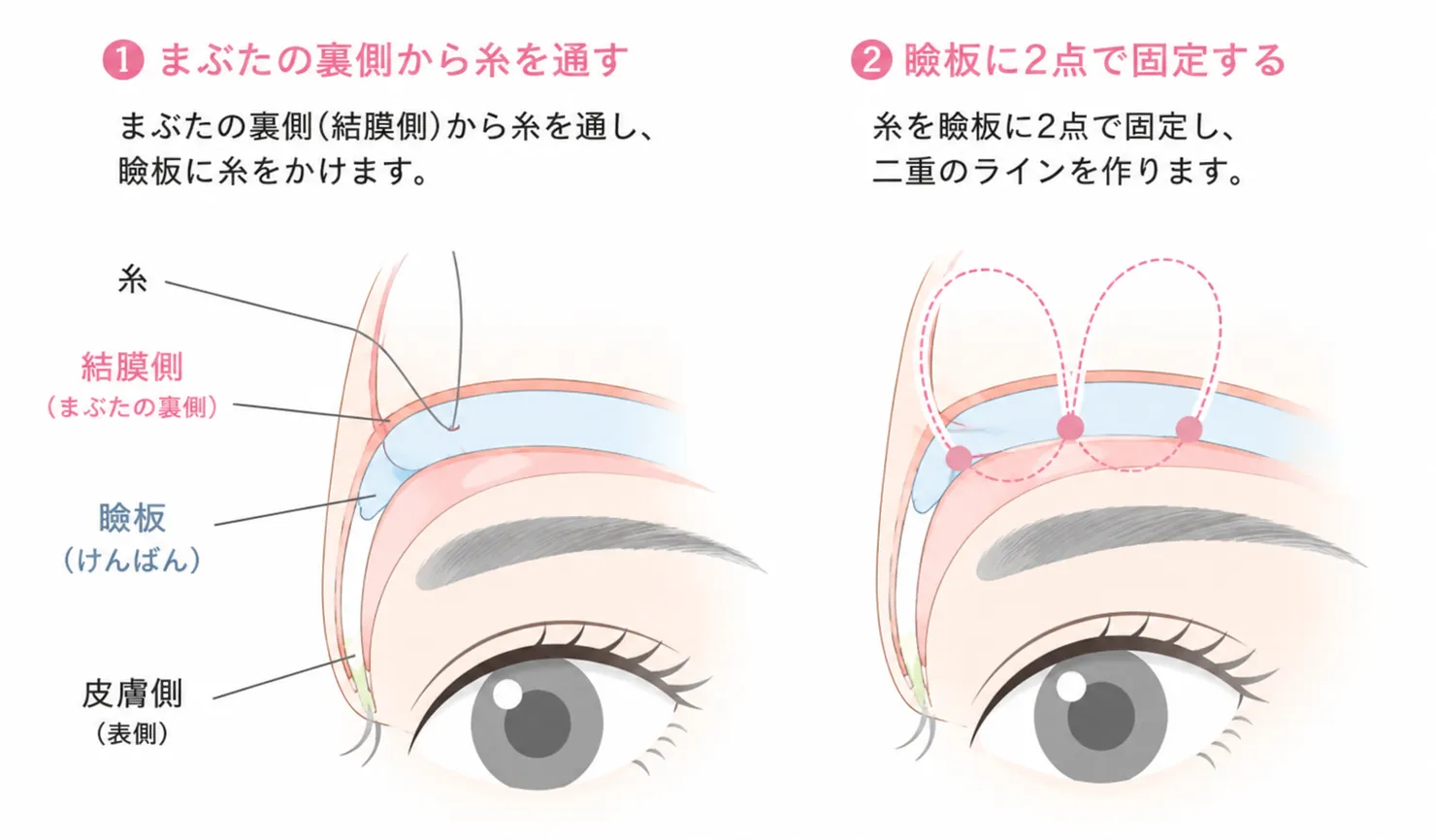 瞼板法(表2点留め)