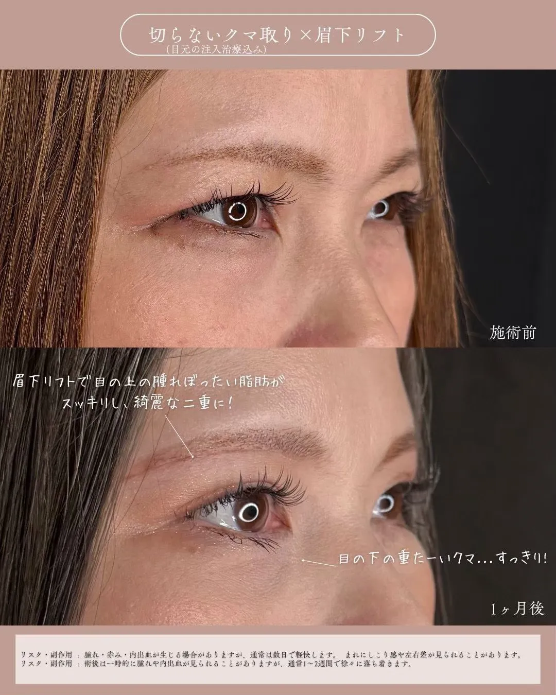 クマ取りセット＋眉下切開1_右横説明あり Before/After